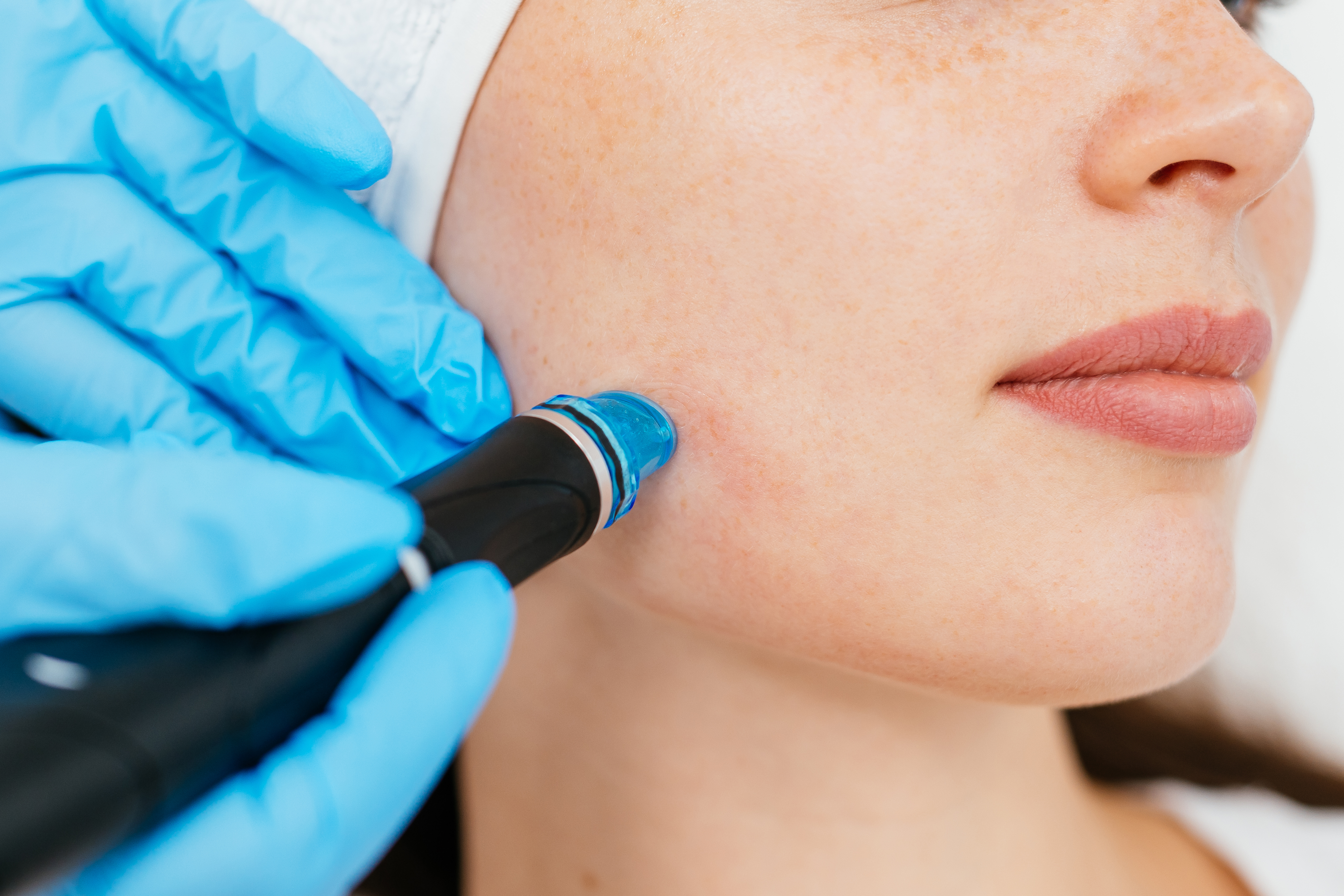 Dermapen Treatment